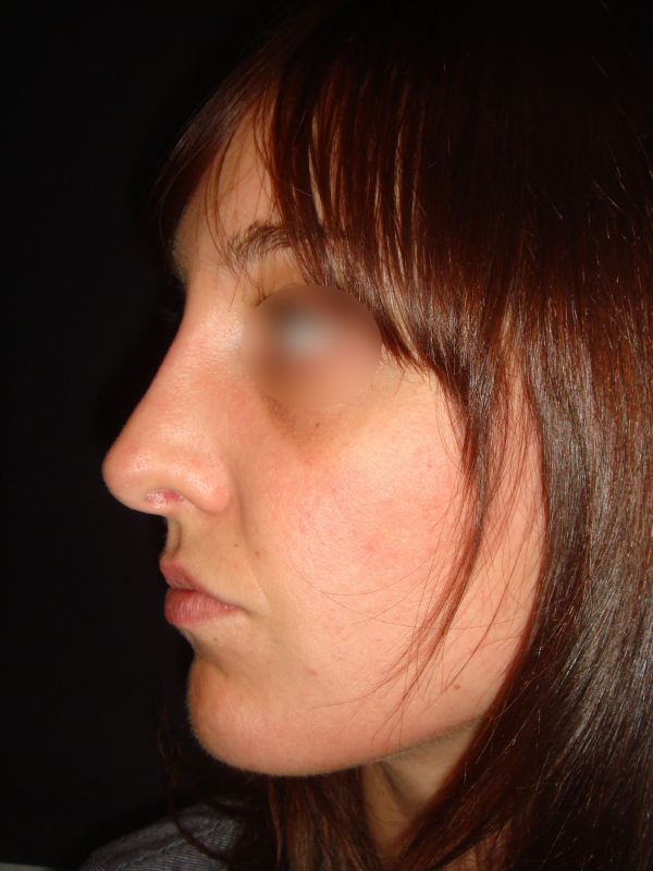 Suivi et évolution d’une rhinoplastie